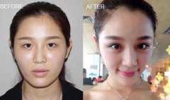 哪些人不适合做双眼皮修复手术