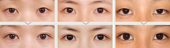 双眼皮术后如何护理才能恢复较快