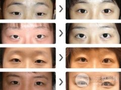 做埋线双眼皮的时候疼吗，多久可以恢复