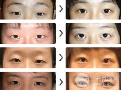 做埋线双眼皮的时候疼吗,多久可以恢复