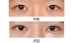 眼睛太肿可以做双眼皮手术吗