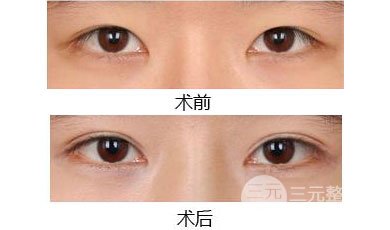 眼睛太肿可以做双眼皮手术吗