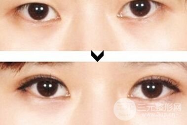 埋线双眼皮果不满意可以取出线吗