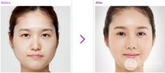 双眼皮手术和纹美瞳线可以一起做吗