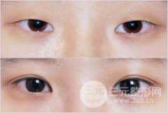 为什么说埋线双眼皮好，有什么优点