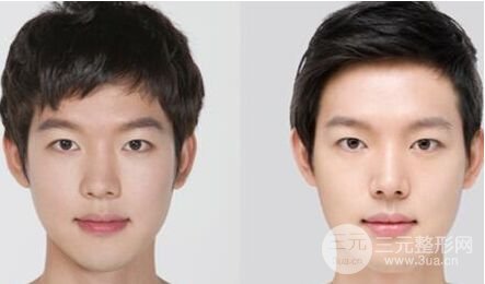 假体隆鼻失败后假体可以取出吗，多久恢复