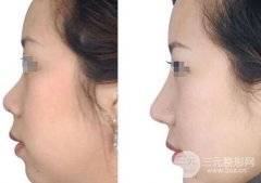 玻尿酸隆鼻真的好吗，为什么这么受欢迎