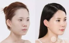 为什么注射玻尿酸隆鼻之后鼻梁会变宽
