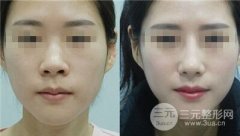 自体软骨隆鼻好吗、有什么优点 自体软骨隆鼻好吗、有什么优点