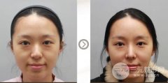 注射玻尿酸隆鼻之后几天能戴眼镜