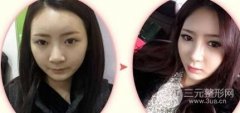 经期能不能做注射隆鼻，有坏处吗