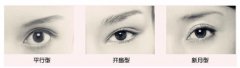 成都埋线双眼皮价格 埋线双眼皮能保持多久