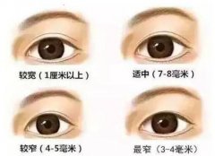 西安西京双眼皮埋线好还是割的好