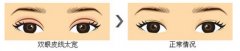 双眼皮失败后多久可以修复 果如何