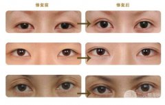 北京双眼皮修复多少钱  双眼皮修复价格