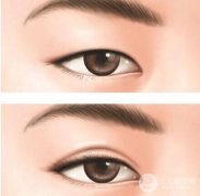 八大处双眼皮失败修复价格 双眼皮失败修复多少钱