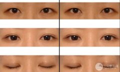 武汉割双眼皮失败修复要做哪些准备