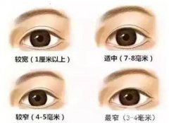 双眼皮特点及恢复时间