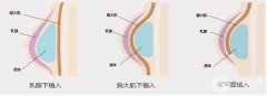 隆胸常识知多少 假体隆胸都有哪些材料