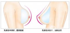 整胸去哪里喜欢 妙桃丰胸合适哪些人 整胸去哪里喜欢 妙桃丰胸合适哪些人