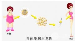 自体脂肪隆胸后多久才能恢复 自体脂肪隆胸后多久才能恢复