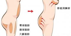 自体脂肪丰胸价格多少 自体脂肪隆胸果如何? 自体脂肪丰胸价格多少 自体脂肪隆胸果如何?