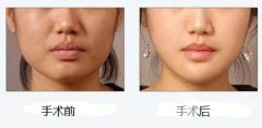 国字脸变瓜子脸？改脸型手术下颌角截骨整形的手术是怎样的？