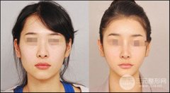 下颌角外翻怎么办？下颌角肥大要怎样矫正？