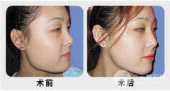 自述，下颌角截骨整形是怎样的感受