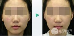 下颌角磨骨手术失败的原因原来是这些！