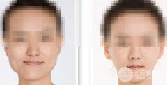 下颌角磨骨整形手术常见的问题解答