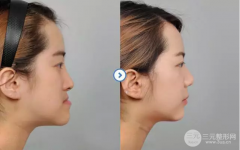 地包天矫正果怎么样？地包天矫正的手术过程是怎样的？