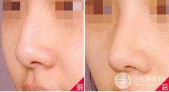 驼峰鼻鹰钩鼻怎样矫正？鹰钩鼻不同的矫正方法