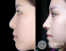 自体软骨隆鼻多少钱 哪些人不适合做自体软骨隆鼻? 自体软骨隆鼻多少钱 哪些人不适合做自体软骨隆鼻?
