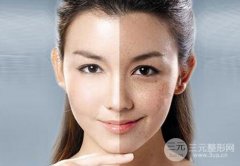 激光去黄褐斑后会不会反弹？要注意哪些？