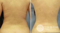 吸脂减肥果好不好？可以减轻体重吗？