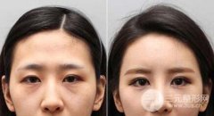 玻尿酸和自体脂肪,哪个填充泪沟果更好? 玻尿酸和自体脂肪,哪个填充泪沟果更好?