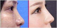 鼻部整形自体软骨材料隆鼻有哪些优势