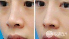 鼻部整形鼻头缩小方法具体有哪些呢?