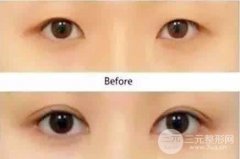 眼睑内双可以做双眼皮手术吗?