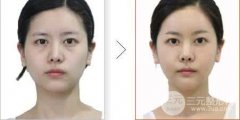 眼部整形去眼袋的注意事项有哪些 眼部整形去眼袋的注意事项有哪些