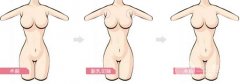 副乳切除会不会影响胸部发育?多少钱?切除前后对比果 副乳切除会不会影响胸部发育?多少钱?切除前后对比果