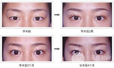 埋线双眼皮的果能保持几年，是永.久性的吗