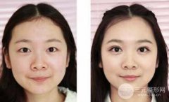双眼皮整形术后会留下疤痕吗