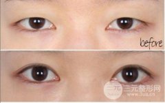做埋线双眼皮要拆线吗、多久可以恢复