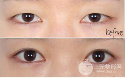 做埋线双眼皮要拆线吗、多久可以恢复