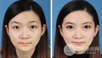 如何选择适合自己的双眼皮手术方式