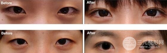 双眼皮整形手术后能不能化妆