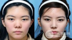 隆鼻假体可以取出吗,取出困难吗 隆鼻假体可以取出吗,取出困难吗