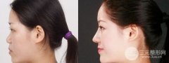 假体隆鼻术后可以戴眼镜吗,有影响吗 假体隆鼻术后可以戴眼镜吗,有影响吗